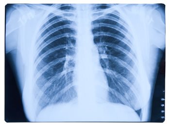 The Life-Ending Prognosis of Mesothelioma