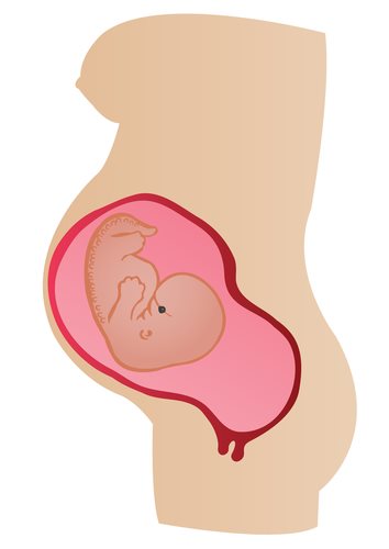 Roe v. Wade